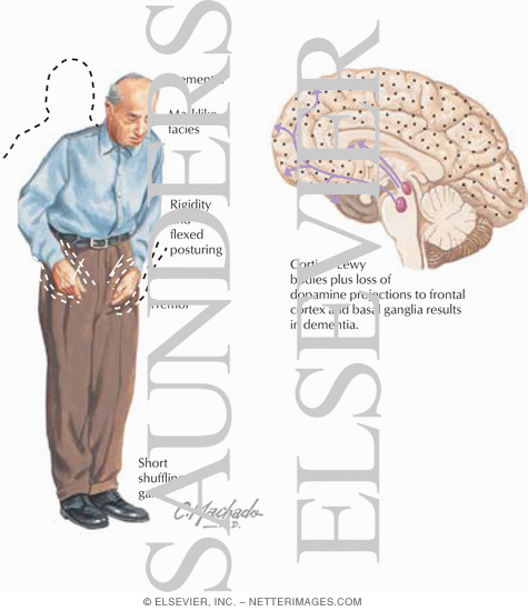 Dementia With Lewy Bodies