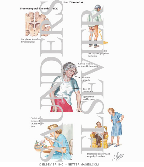 Watermarked preview of labeled image: Frontotemporal Dementia