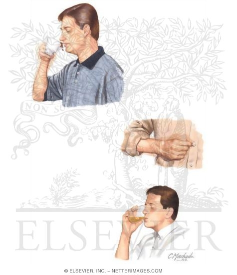 Essential Tremor
