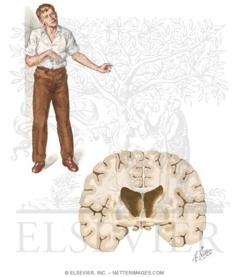 Huntington's Disease