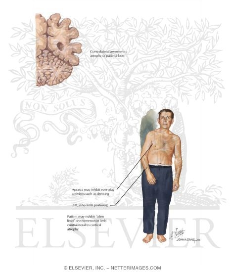Watermarked preview of labeled image: Corticobasal Degeneration