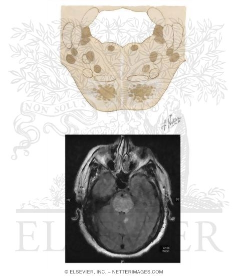 Central Pontine Myelinolysis