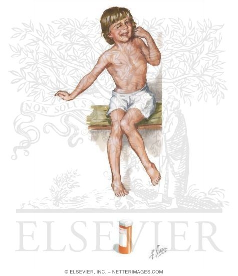 Tardive Dyskinesia