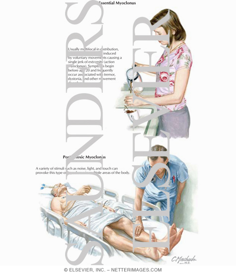 Essential Myoclonus