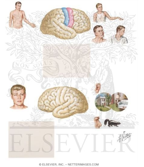 Parital Seizures