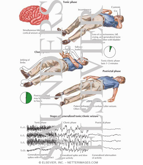 Generalized Tonic Clonic Seizures