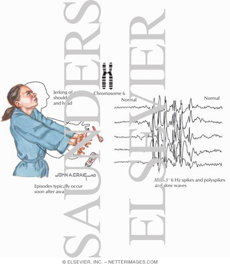 Juvenile Myoclonic Epilepsy