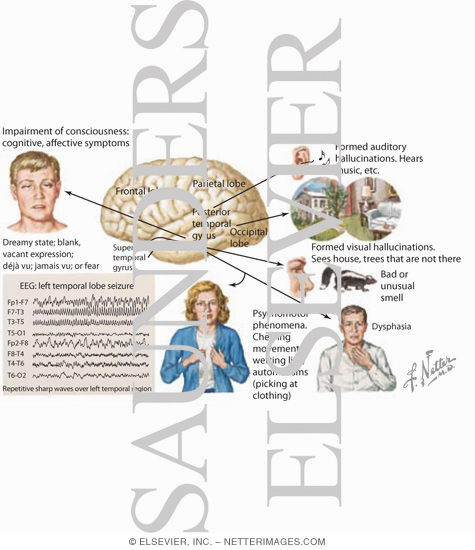 Complex Partial Seizures