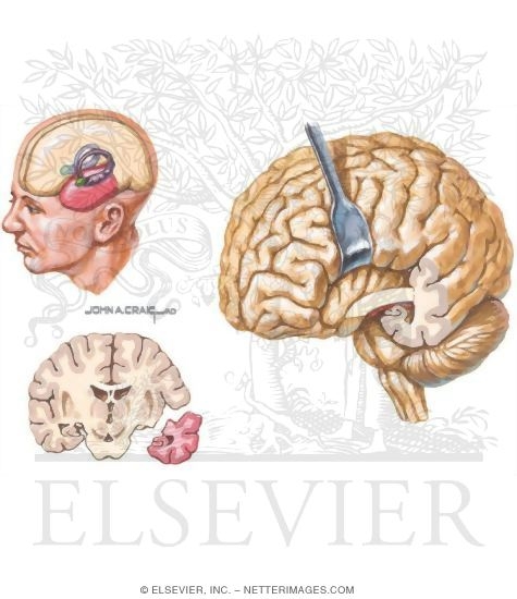 Watermarked preview of unlabeled image: Surgical Treatments for Epilepsy