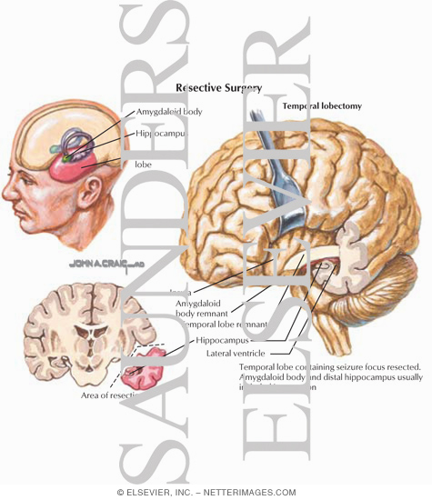 Watermarked preview of labeled image: Surgical Treatments for Epilepsy