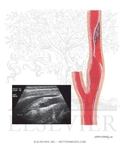 Arterial Dissection