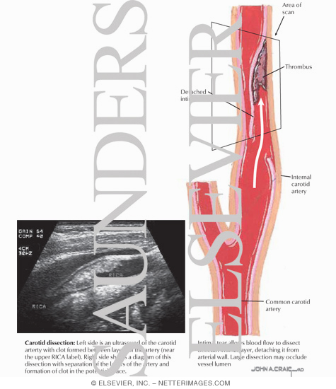 Arterial Dissection