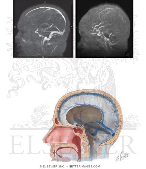Venous Infarction