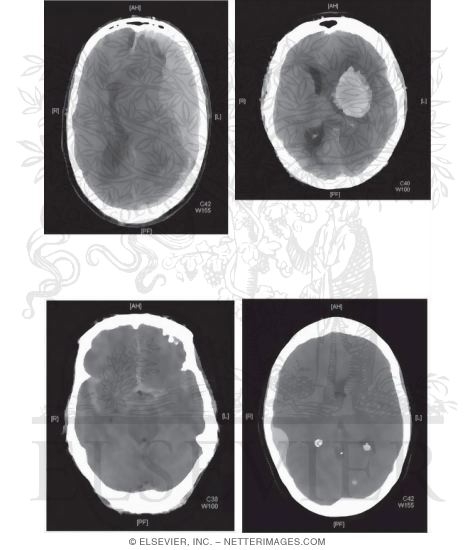 Watermarked preview of unlabeled image: General Features of Hemorrhage