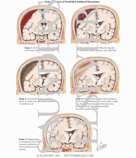Watermarked preview of labeled image: Natural History of Nonlethal Subdural Hematoma