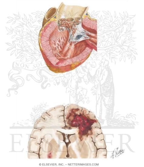 Subacute Bacterial Endocarditis