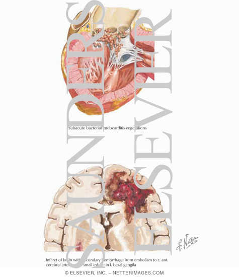 Watermarked preview of labeled image: Subacute Bacterial Endocarditis