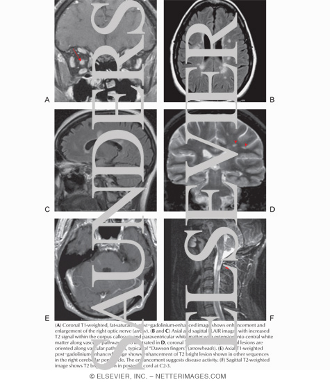 Watermarked preview of labeled image: Multiple Sclerosis