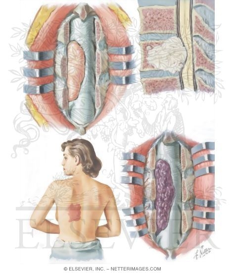 Spinal Cord Tumors