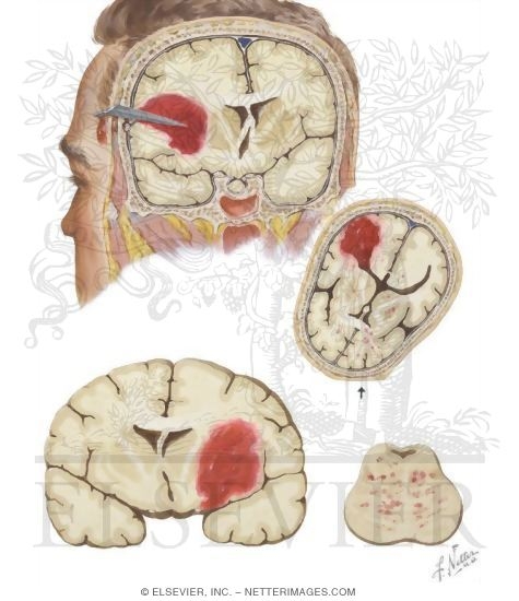 Intracerebral Hematoma