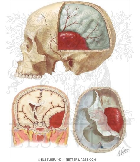 Extradural Hematoma