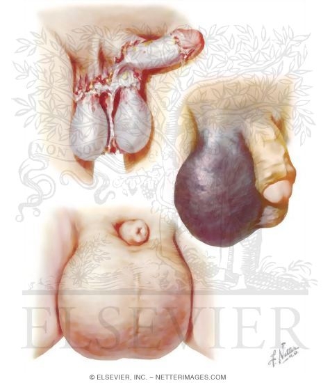 Avulsion Edema, Hematoma