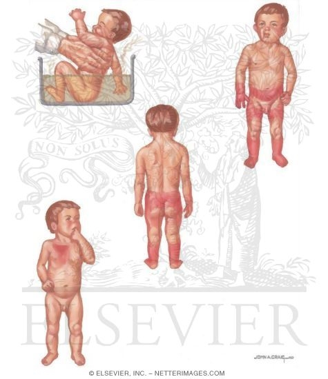 Watermarked preview of unlabeled image: Child Abuse: Immersion and Scald Injuries
