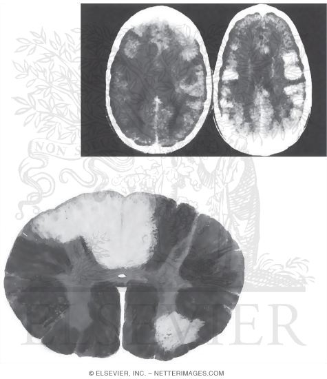 Acute Disseminated Encephalomyelitis (ADEM) and Multiple Sclerosis: Central Nervous System Pathology