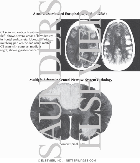 Acute Disseminated Encephalomyelitis (ADEM) and Multiple Sclerosis