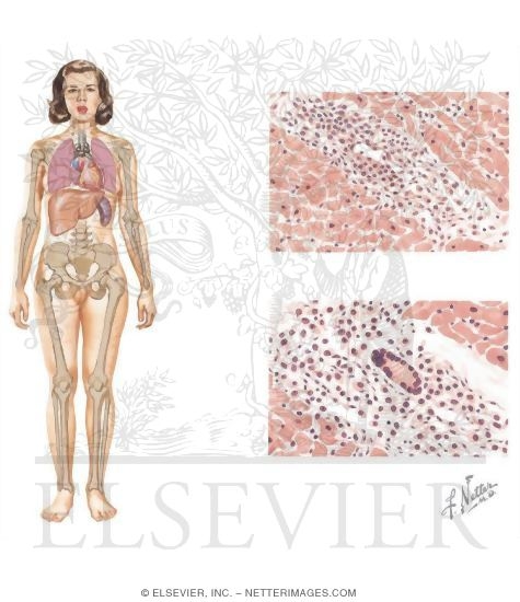 Watermarked preview of unlabeled image: Sarcoidosis