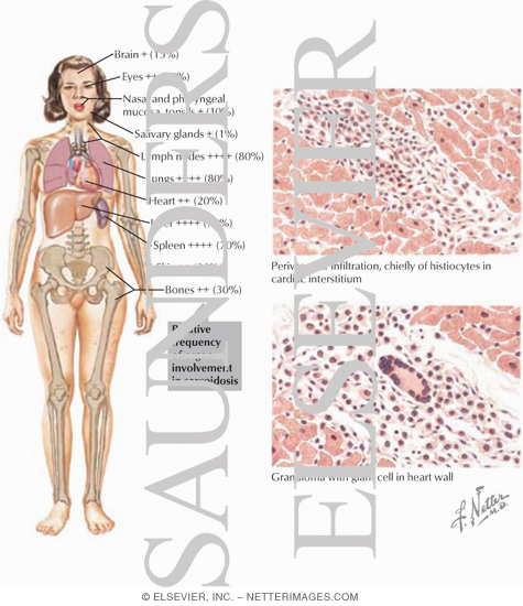 Watermarked preview of labeled image: Sarcoidosis