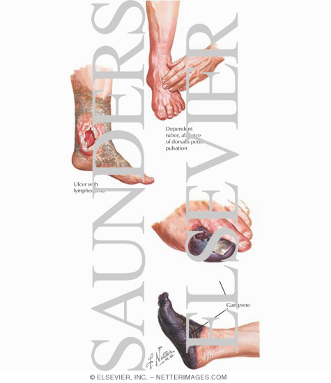 Watermarked preview of labeled image: Diabetic Neuropathy