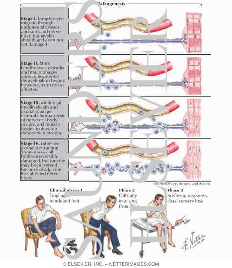 AIDP (Guillain-Barre Syndrome)