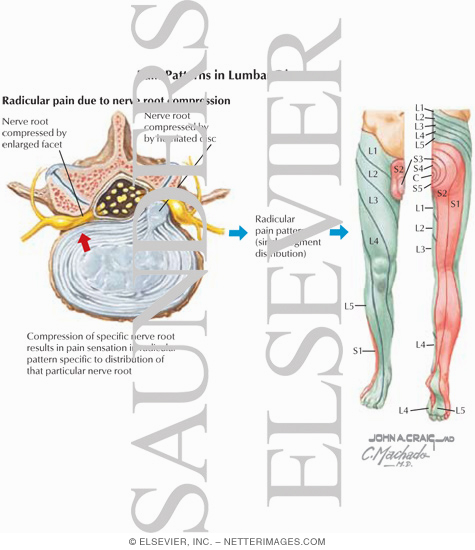 Lumbosacral Radiculopathy