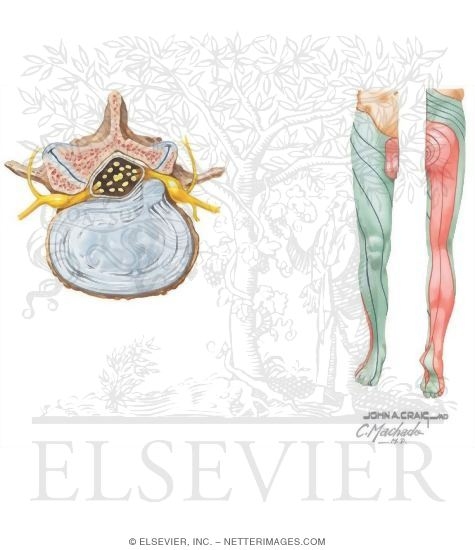 Lumbosacral Radiculopathy