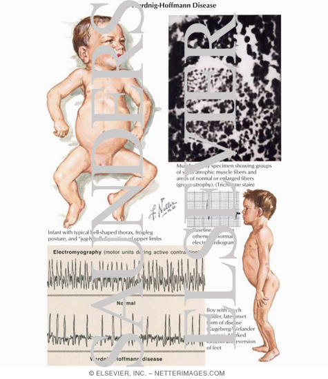 Watermarked preview of labeled image: Werdnig-Hoffmann Disease
