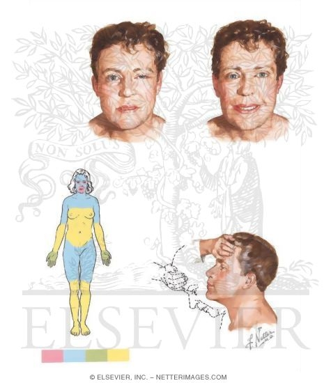 Watermarked preview of unlabeled image: Myasthenia