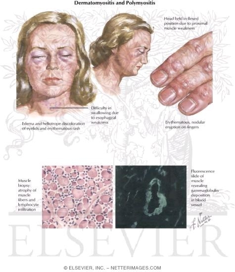 Dermatomyositis and Polymyositis