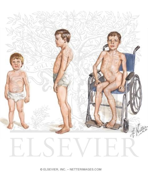 Watermarked preview of unlabeled image: Muscular Dystrophies