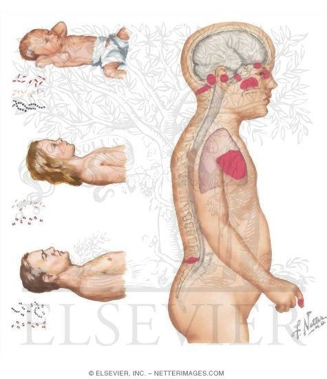Watermarked preview of unlabeled image: Bacterial Meningitis