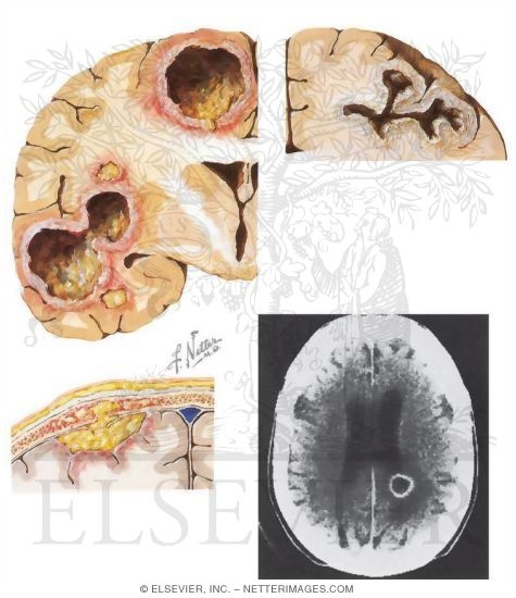 Watermarked preview of unlabeled image: Parameningeal Infections and Subdural Abscess