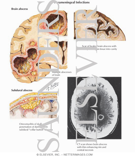 Watermarked preview of labeled image: Parameningeal Infections and Subdural Abscess