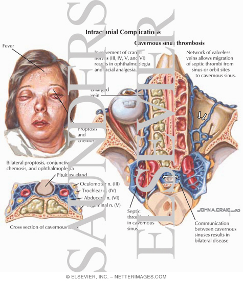 Septic Thrombophlebitis