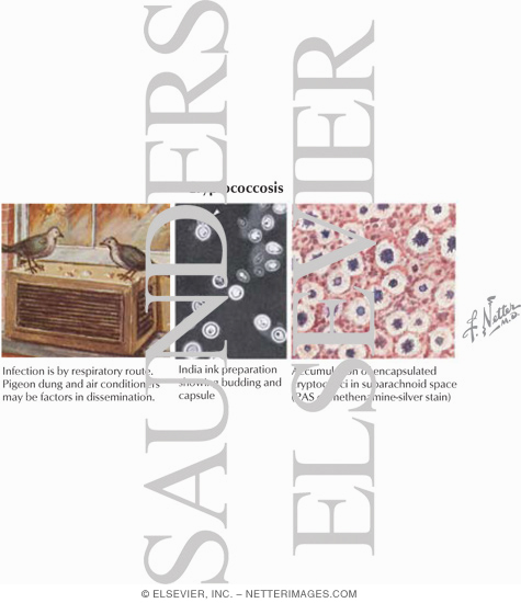 Watermarked preview of labeled image: Fungal Meningitis