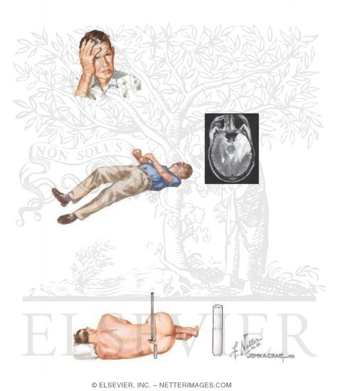 Watermarked preview of unlabeled image: Clinical Features of HSV Encephalitis