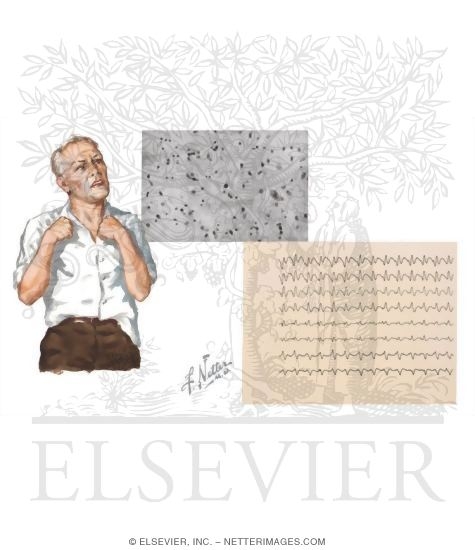Watermarked preview of unlabeled image: Prion Diseases