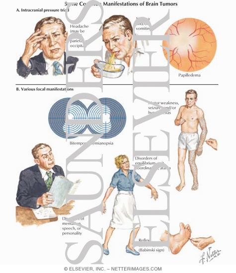 Watermarked preview of labeled image: Some Common Manifestations of Brain Tumors