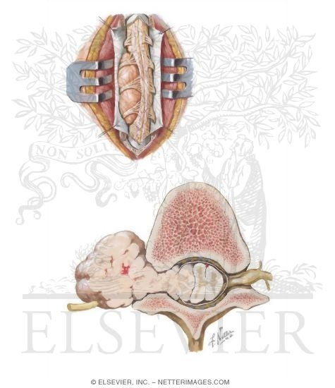 Watermarked preview of unlabeled image: Spinal Cord Tumors