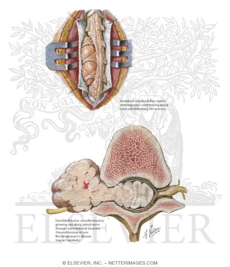 Watermarked preview of labeled image: Spinal Cord Tumors