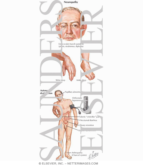 Watermarked preview of labeled image: Diabetes Mellitus